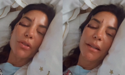 Ivete Sangalo surge com o rosto machucado após queda e tranquiliza fãs: "Estou bem"